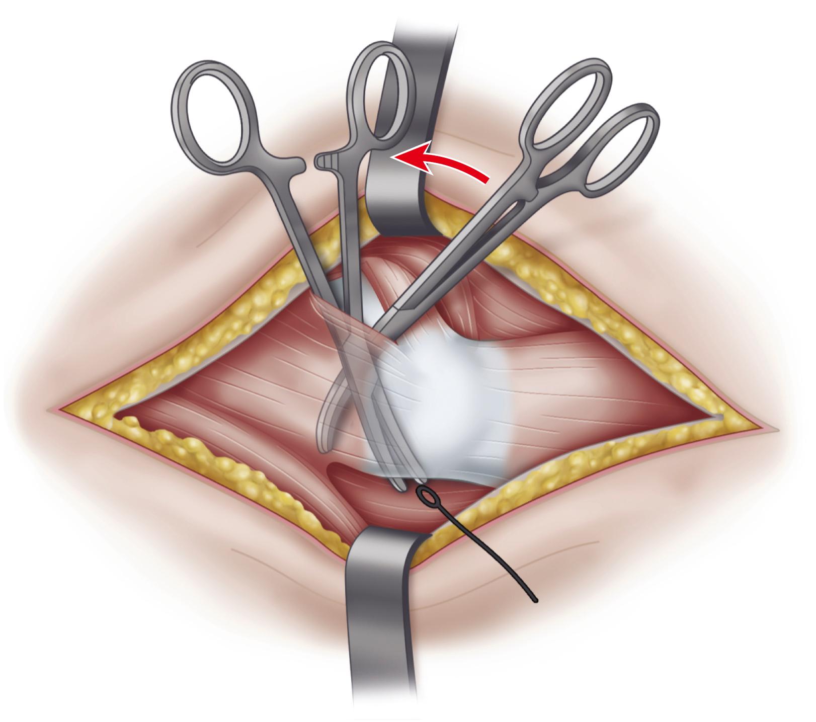 FIGURE 3.71, Gallbladder clamp is inserted into joint and pushed through capsule posterior to insertion of gluteus medius to grasp Gigli saw (see text).