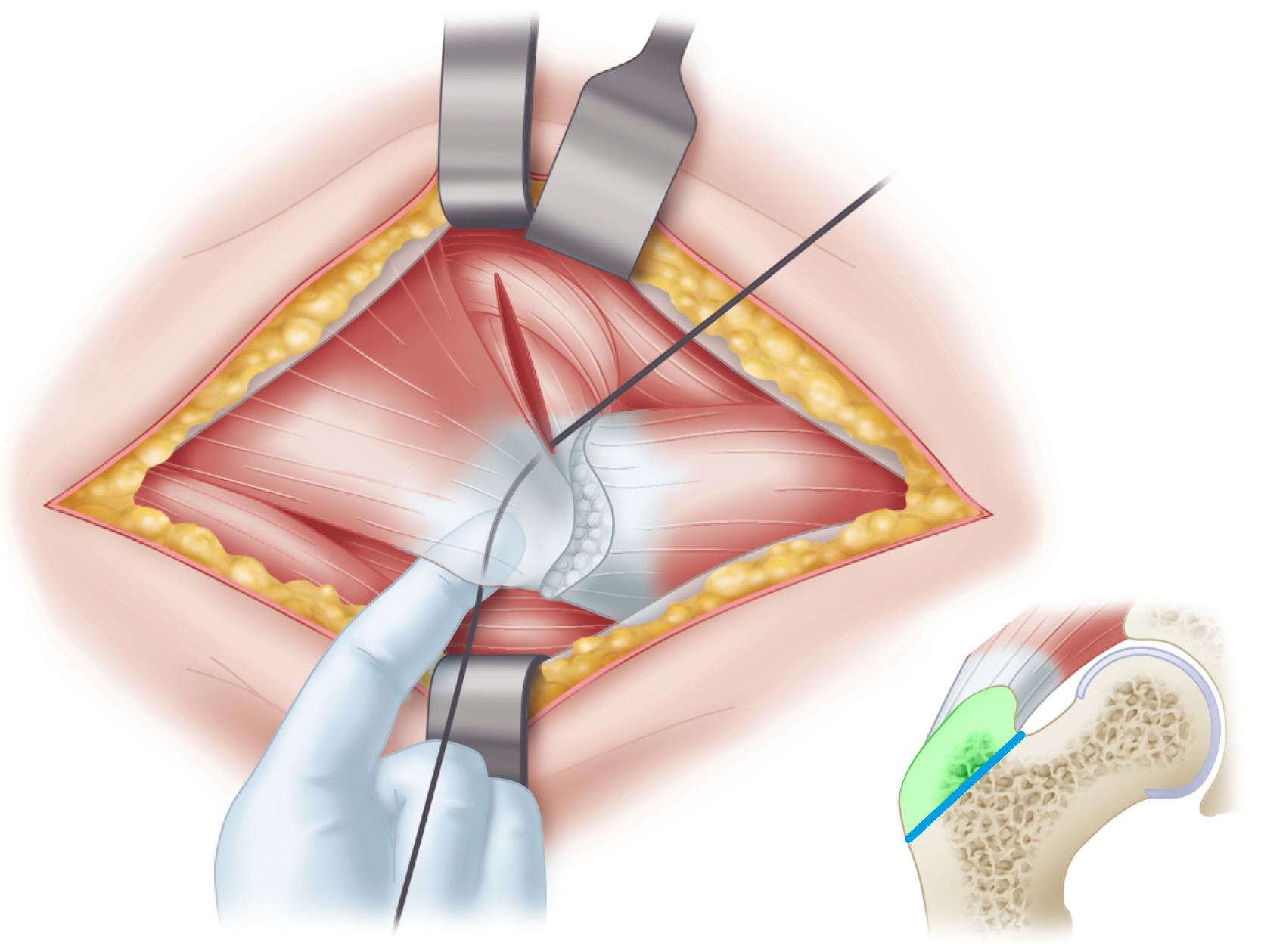 FIGURE 3.72, Before trochanter is osteotomized, finger is used to ensure that Gigli saw is sufficiently posterior and sciatic nerve is not trapped between saw and bone. Inset, Direction of osteotomy is first distal and then lateral to detach trochanter just proximal to abductor tubercle.