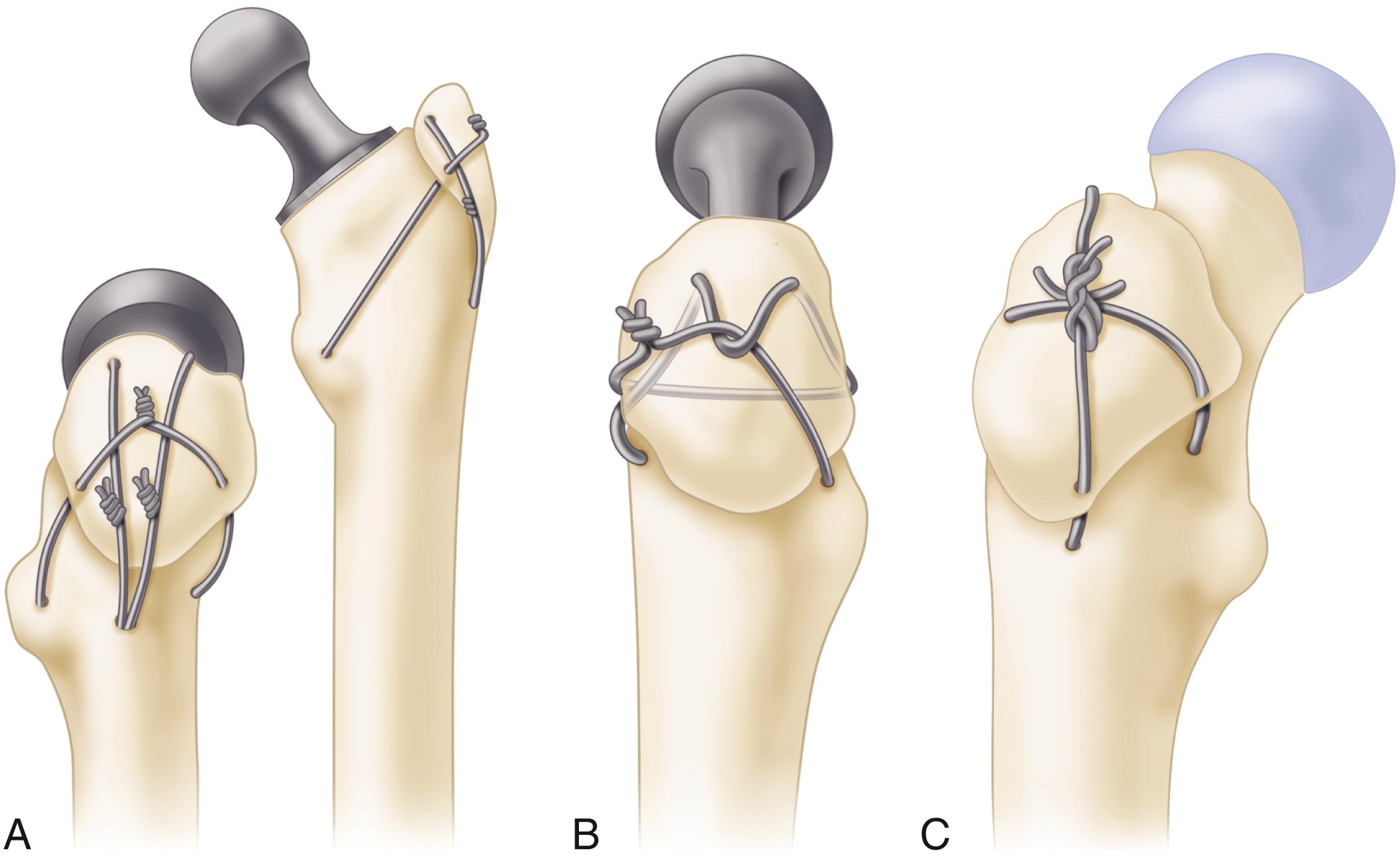 FIGURE 3.74, Wire fixation of trochanter. A, Two vertical wires are inserted in hole drilled in lateral cortex below abductor tubercle; they emerge from cut surface of neck, and one is inserted in hole in osteotomized trochanter. Two vertical wires are tightened and twisted, and transverse wire that was inserted in hole drilled in lesser trochanter and two holes in osteotomized trochanter is tightened and twisted. B, One-wire technique of Coventry. After component has been cemented in femur, two anteroposterior holes are drilled in femur beneath osteotomized surface and two holes are drilled in osteotomized trochanter. One end of wire is inserted through lateral loop before being tightened and twisted. C, Oblique interlocking wire technique of Amstutz for surface replacement.