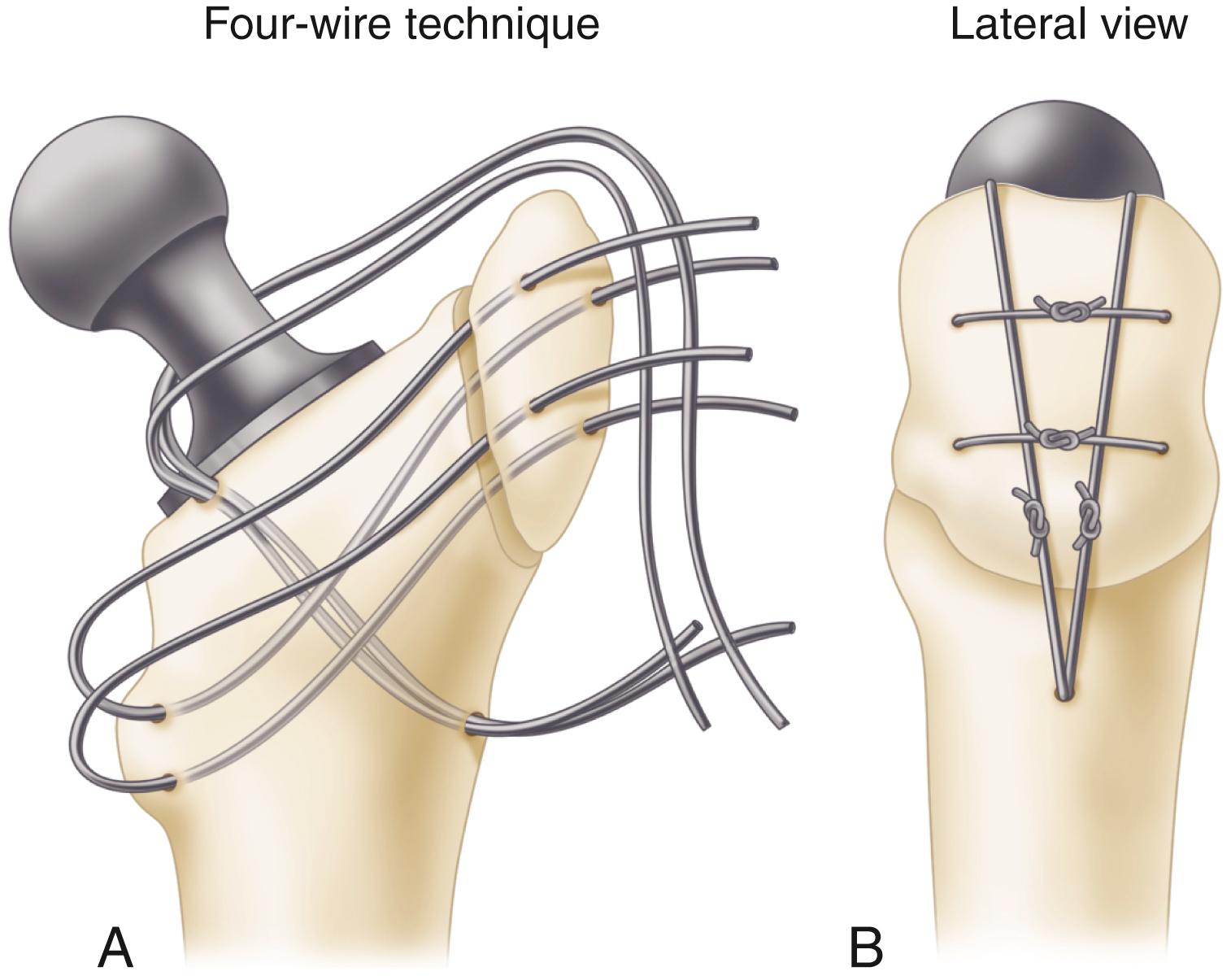 FIGURE 3.75, Harris four-wire technique of reattachment of trochanter. A, Two vertical wires are inserted through hole drilled in lateral cortex and come out in groove cut in neck of femur so as not to interfere with seating of collar. Two transverse wires are inserted in holes in lesser trochanter and in two holes in osteotomized greater trochanter. B, Two transverse wires are tied over two tied vertical wires. One transverse wire can be used instead of two.