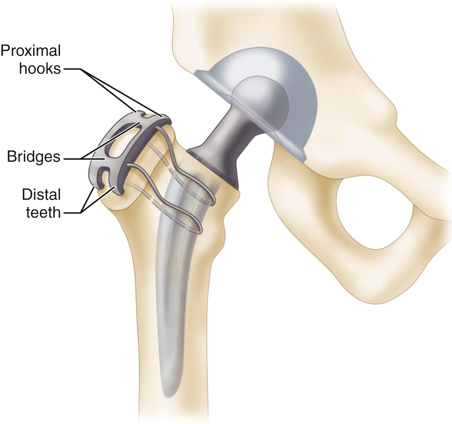 FIGURE 3.76, Dall-Miles cable grip device for reattachment of trochanter.