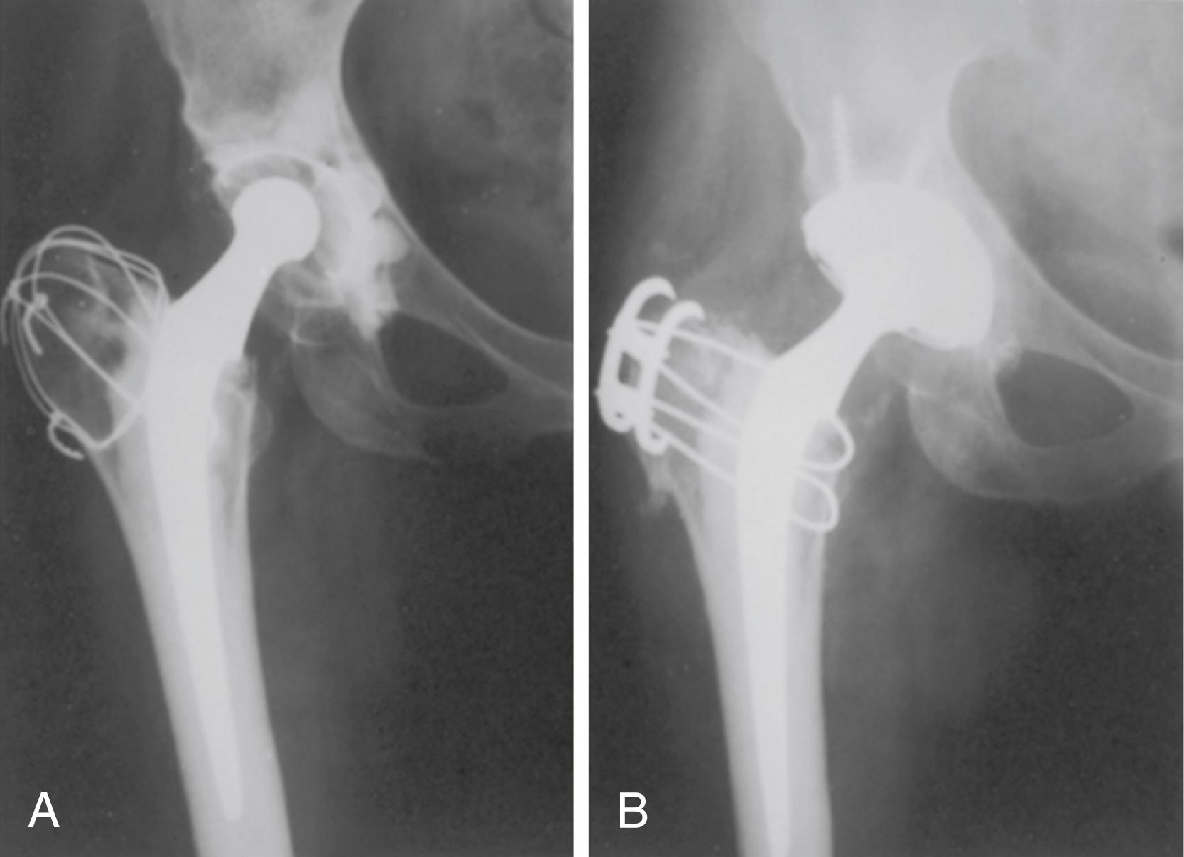 FIGURE 3.77, A, Fifteen years after Charnley total hip replacement, acetabular loosening and wear are apparent, but there is no evidence of femoral loosening. B, Exposure for acetabular revision was improved by trochanteric slide osteotomy, leaving femoral component intact. Reattachment was secured with cable fixation device (Dall-Miles). Wires are completely extramedullary and do not violate femoral cement mantle. Union was complete at 3 months.