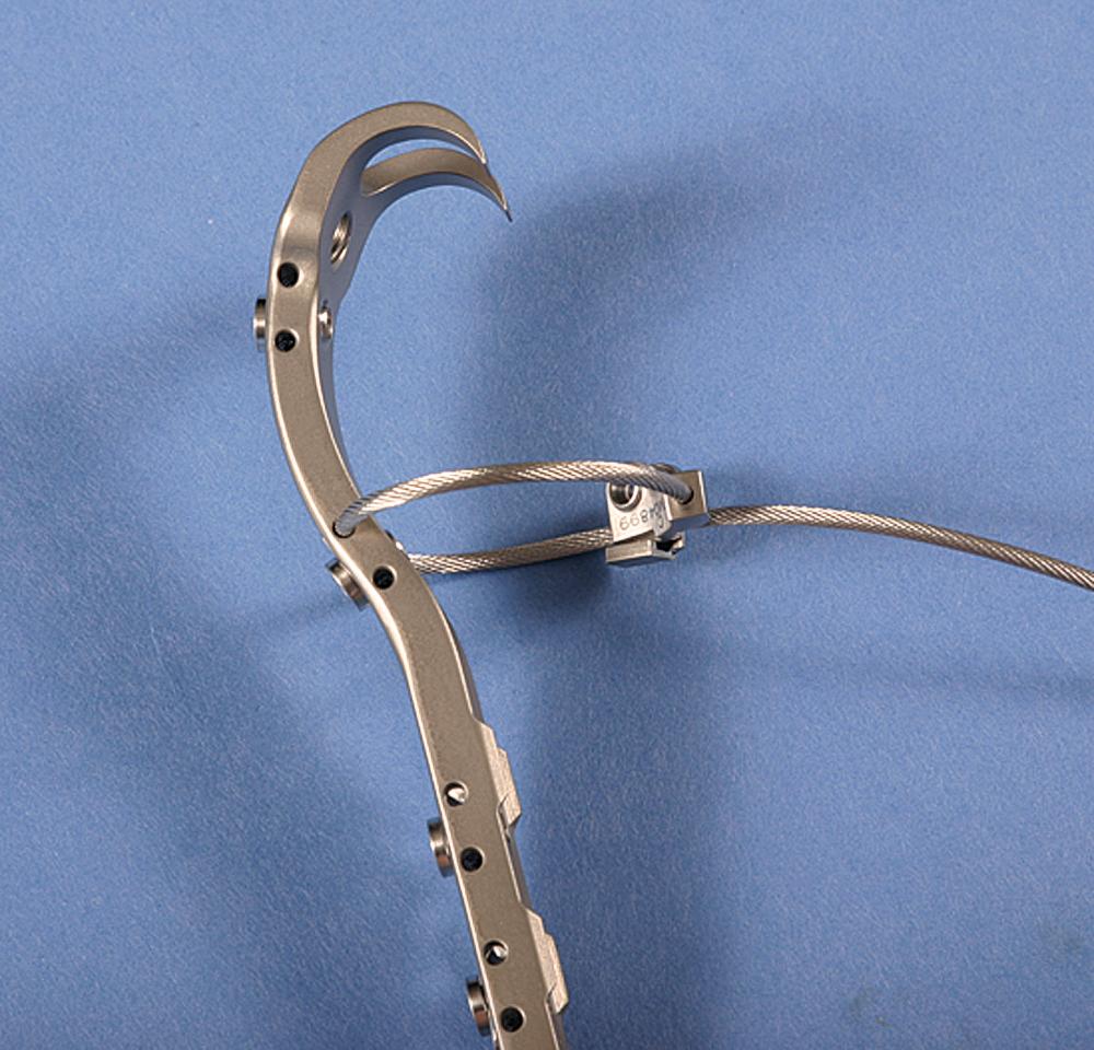 FIGURE 3.78, Accord trochanteric fixation plate. Trochanteric fragment is captured by proximal hooks. Plate extension is fixed to femur with cerclage cables and can be used to stabilize standard or extended trochanteric osteotomy.