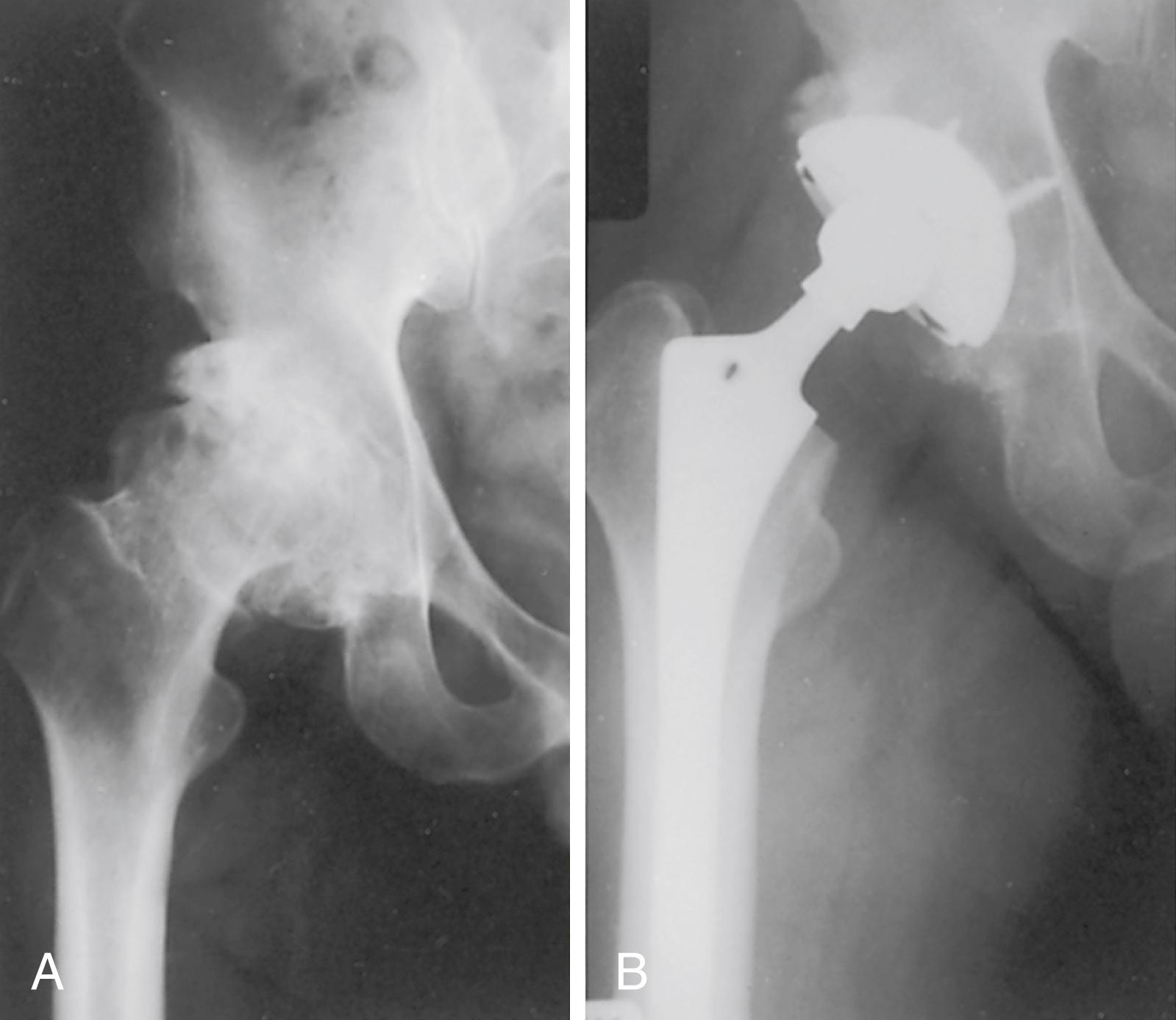 FIGURE 3.80, Inadequate deepening of acetabulum. A and B, Degenerative arthritis with intraarticular osteophyte formation and lateral subluxation. Medial osteophytes were not removed, and socket remains in lateralized position. Superior coverage is provided only by large osteophyte.