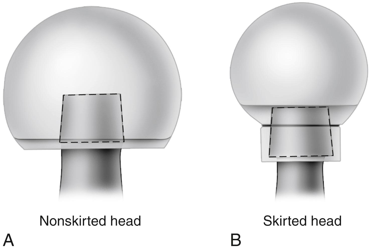 FIGURE 3.8, Head-to-neck ratio of implants. Large-diameter head with trapezoidal neck (A) has greater range of motion and less impingement than smaller diameter head and skirted modular neck (B) .