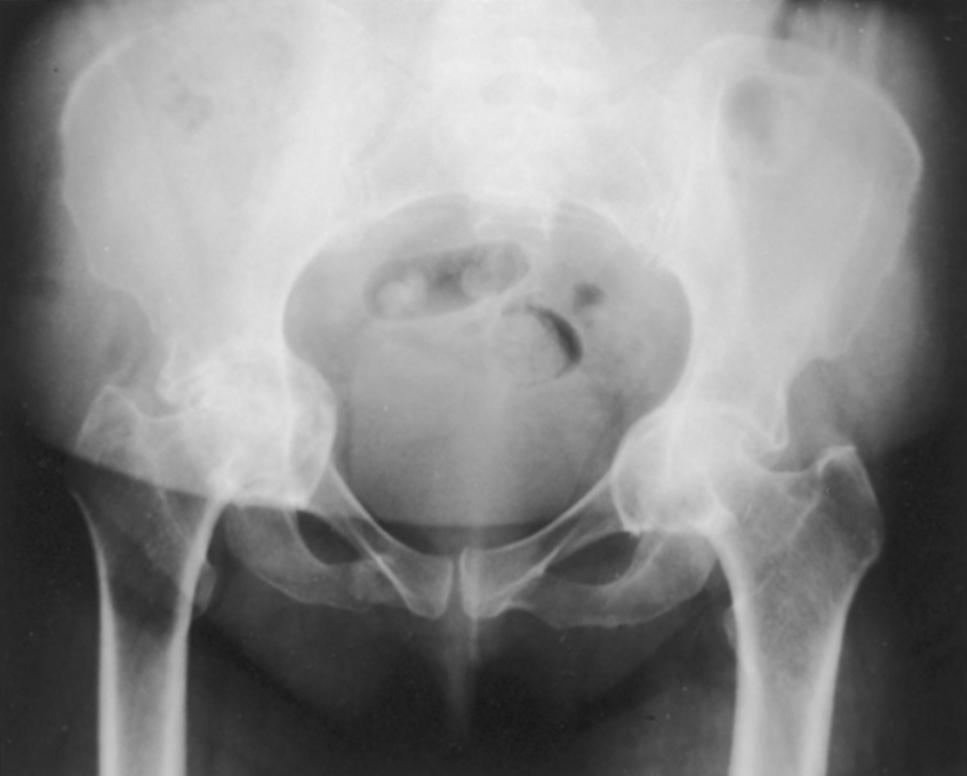FIGURE 3.81, Primary protrusio acetabuli. Otto pelvis in 52-year-old woman. Femoral head has migrated medial to ilioischial (Kohler) line. Hip motion is severely limited.