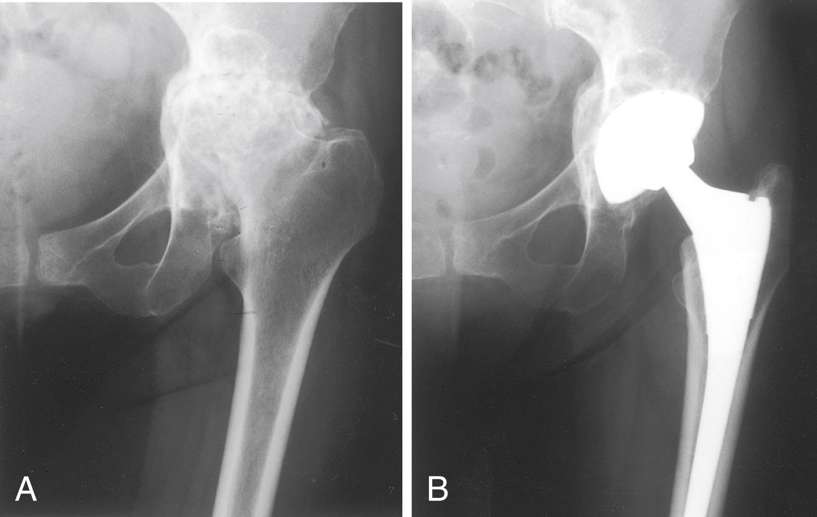 FIGURE 3.82, Reconstruction for protrusio acetabuli deformity. A, Protrusio deformity in 52-year-old woman with lupus. B, After total hip arthroplasty. Hip center was restored to more lateral and inferior position. Large acetabular component allowed rim fixation without need for screws, and medial deficits were grafted with cancellous autograft from femoral head with excellent incorporation. Low neck resection and high-offset stem design helped avoid overlengthening of limb.