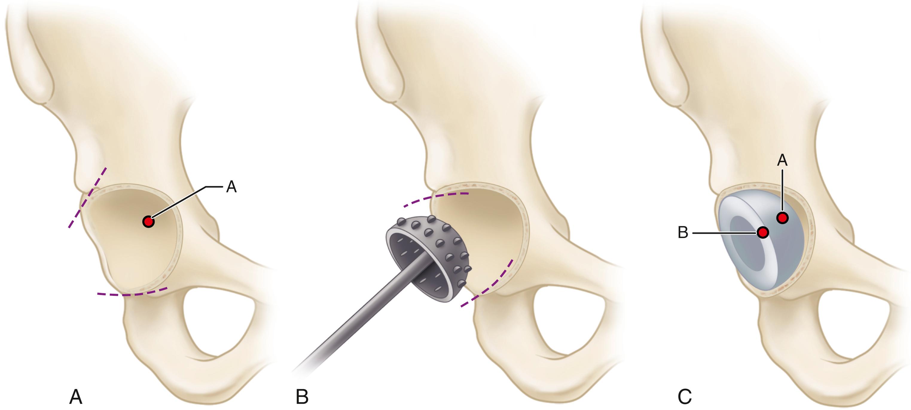 FIGURE 3.83, Insertion of acetabular component for protrusio. A, Peripheries of acetabular walls are divergent, and hip center is displaced superiorly and medially. B, Peripheral reaming creates new rim with convergent walls. C, Implanted component is stable on prepared rim. Hip center shifted from point A to point B and is now in more anatomic location.