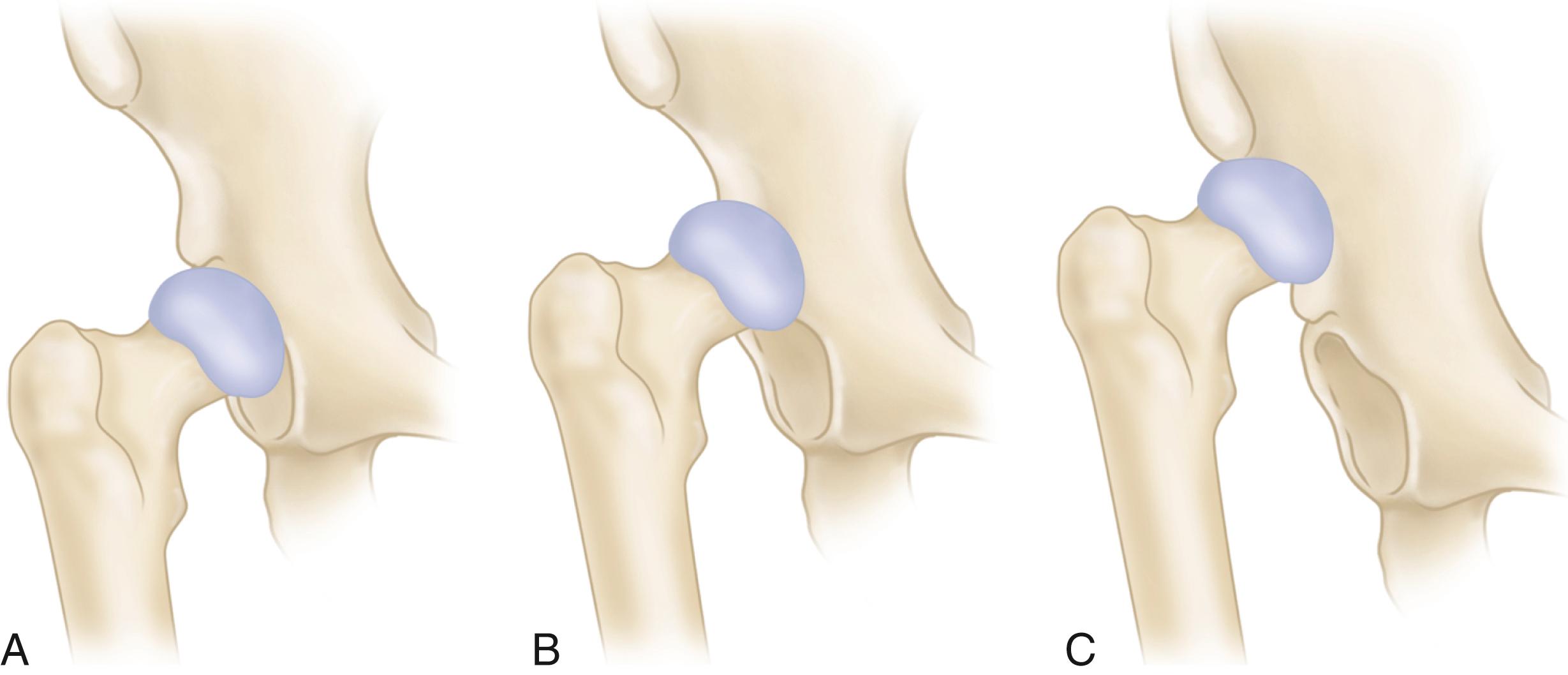 FIGURE 3.84, Developmental subluxation or dislocation. A, Dysplastic hip with defect in superior aspect of acetabulum. B, Intermediate congenital dislocation with false acetabulum above true acetabulum, usually with shallow groove connecting two acetabula. C, High dislocation of hip, with some reactive bone on side of ilium where head impinges on cortex.