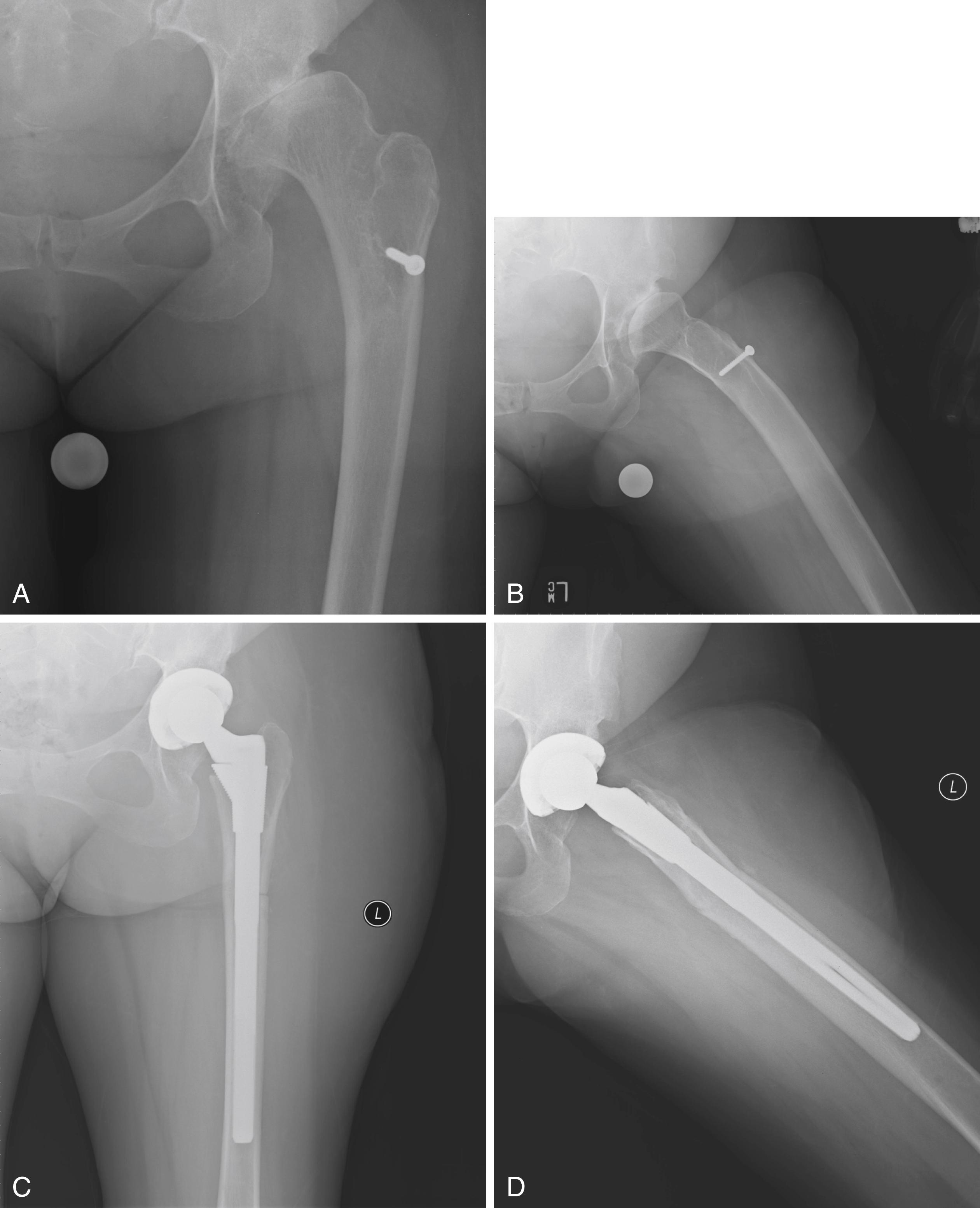 FIGURE 3.85, Developmental dysplasia. A and B, Thirty-year-old woman with prior femoral and acetabular osteotomies. There is residual Crowe type 1 dysplasia. Femur is excessively anteverted with anterior bow and retained hardware. C and D, Small acetabular component placed at level of true acetabulum. Femoral osteotomy was needed to correct angular and rotational deformities.