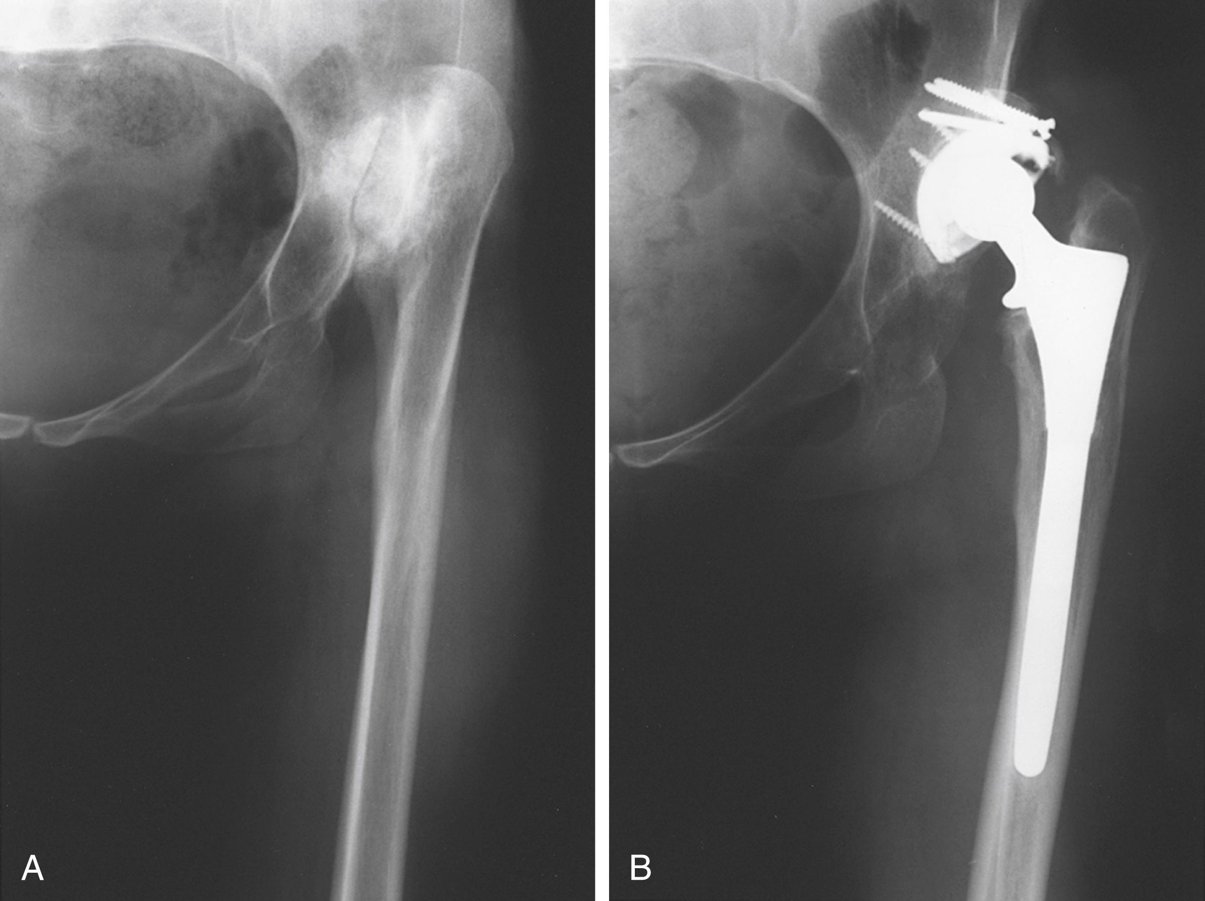 FIGURE 3.86, Placement of cup in false acetabulum. A, Dislocation in 35-year-old woman. B, Cup was implanted in false acetabulum with high hip center. Limb remains 4 cm short, and abductor function is poor.