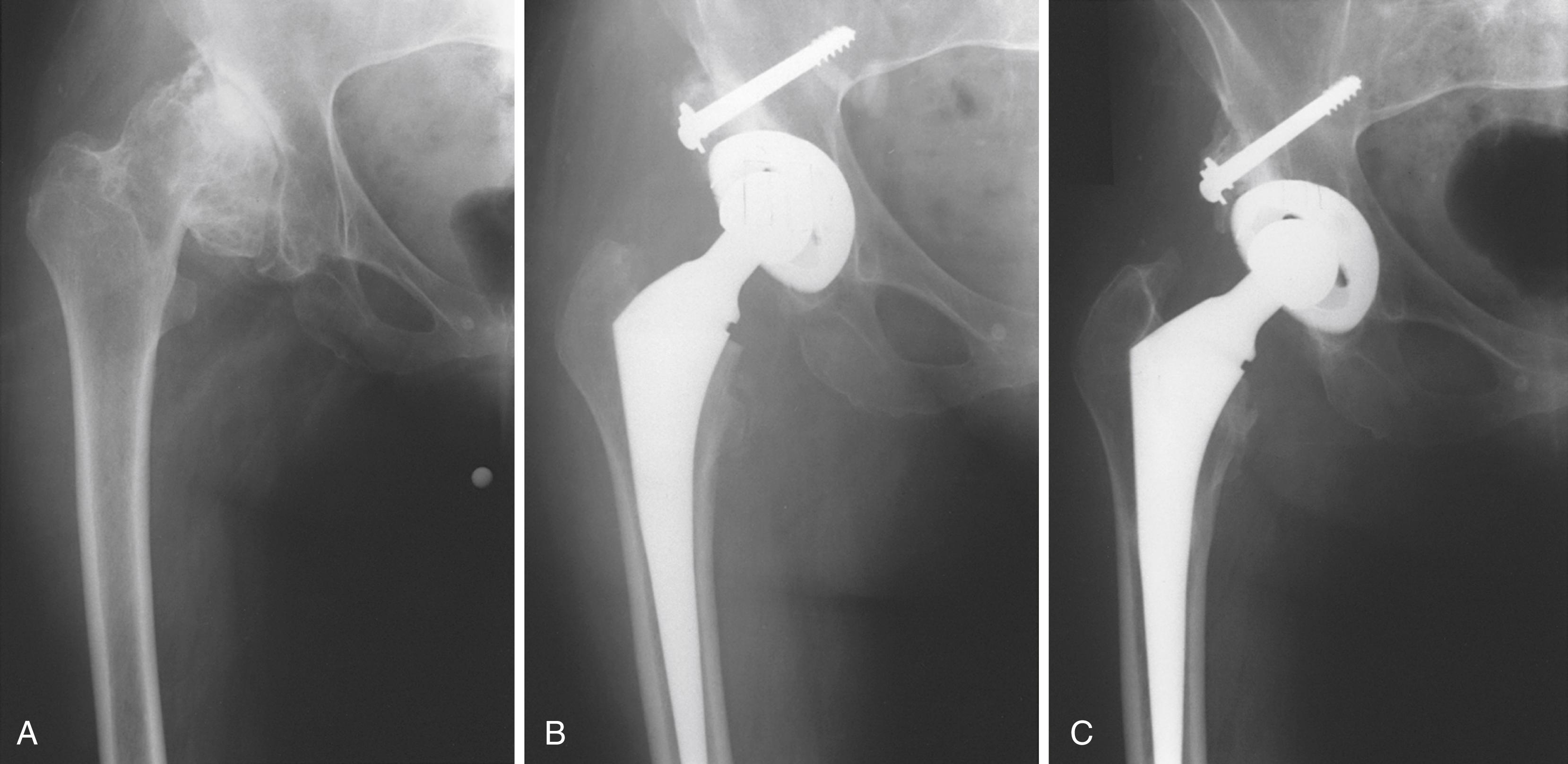 FIGURE 3.87, Grafting of superior segmental defect of acetabulum with part of femoral head. A, Sequelae of dysplasia in 54-year-old woman. B, Cementless socket is placed in true acetabulum. Autogenous graft is fixed with cancellous screws and covers about 30% of implant. C, At 5 years, graft has united and socket is stable.