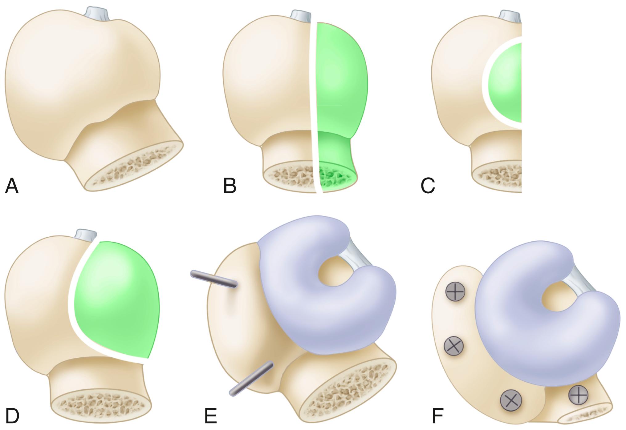FIGURE 3.88, Bone graft, superior and posterior aspect of acetabulum. Large bone bank femoral head with some neck attached (A) is cut in coronal plane (B) so that upper part is slightly more than half of head. C, Full-thickness elliptical piece of bone is cut out with end-cutting reciprocating saw. This concave surface of graft is placed on convex surface of pelvis above and posterior to acetabulum. D, Graft is rotated 90 degrees, and another elliptical cut is made that is slightly smaller than diameter of acetabulum. Several fittings are necessary for graft to have maximal contact with underlying bone. E, Graft is temporarily fixed to underlying bone with two Kirschner wires. F, Four lag screws fix graft to pelvis. High-speed burr and reamers are used to finish contouring graft.