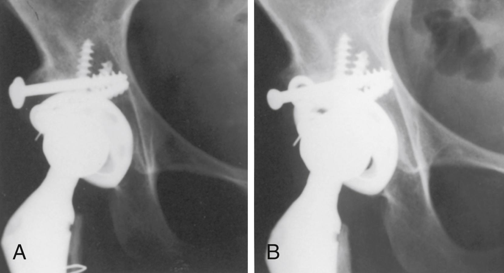 FIGURE 3.89, Resorption of femoral head autograft. A, After total hip arthroplasty with femoral head autograft for superior and posterior segment deficits. Graft is united at 6 months. Portion of graft protrudes beyond edge of component. B, Two years after surgery, unstressed lateral portion of graft has resorbed. Note medial migration of washers. Function is excellent, component shows no migration, and there is no resorption of graft that supports socket.