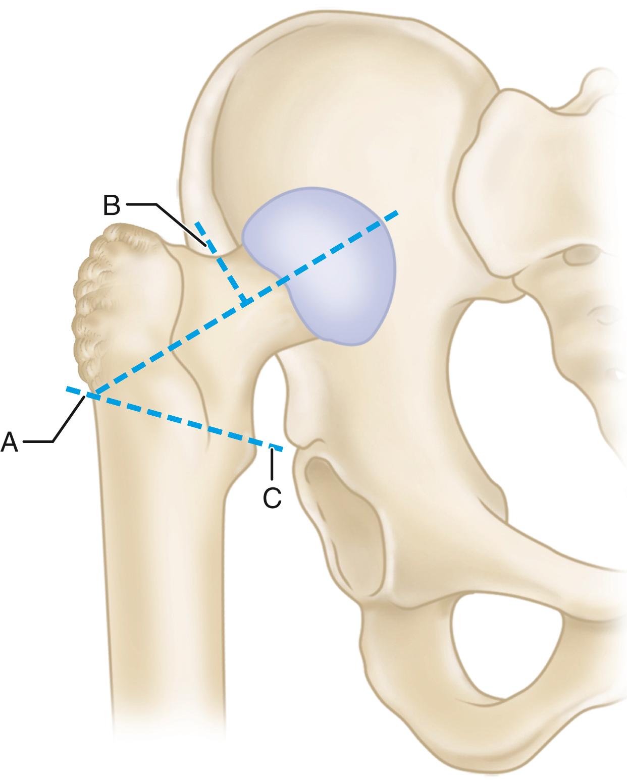 FIGURE 3.90, Dunn and Hess osteotomy of greater trochanter and resection of proximal femoral metaphysis (see text). Trochanter is resected along lines A and B for large fragment to facilitate reattachment and to increase abductor lever arm. Metaphysis is divided at about line C .