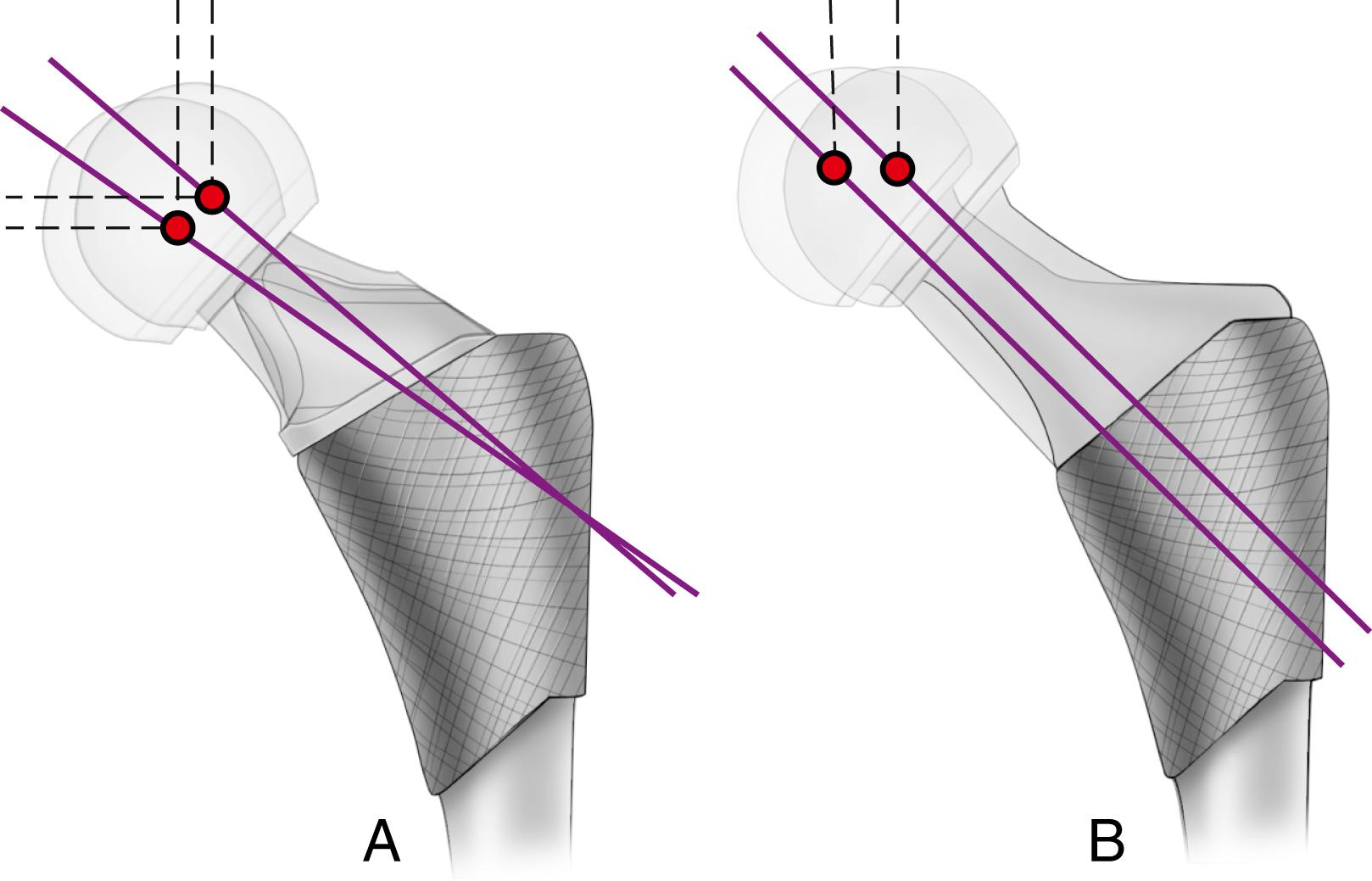 FIGURE 3.9, Variations in femoral component necks to increase offset. A, Neck-stem angle is reduced. B, Neck is attached at more medial position on stem. SEE TECHNIQUE 3.5.