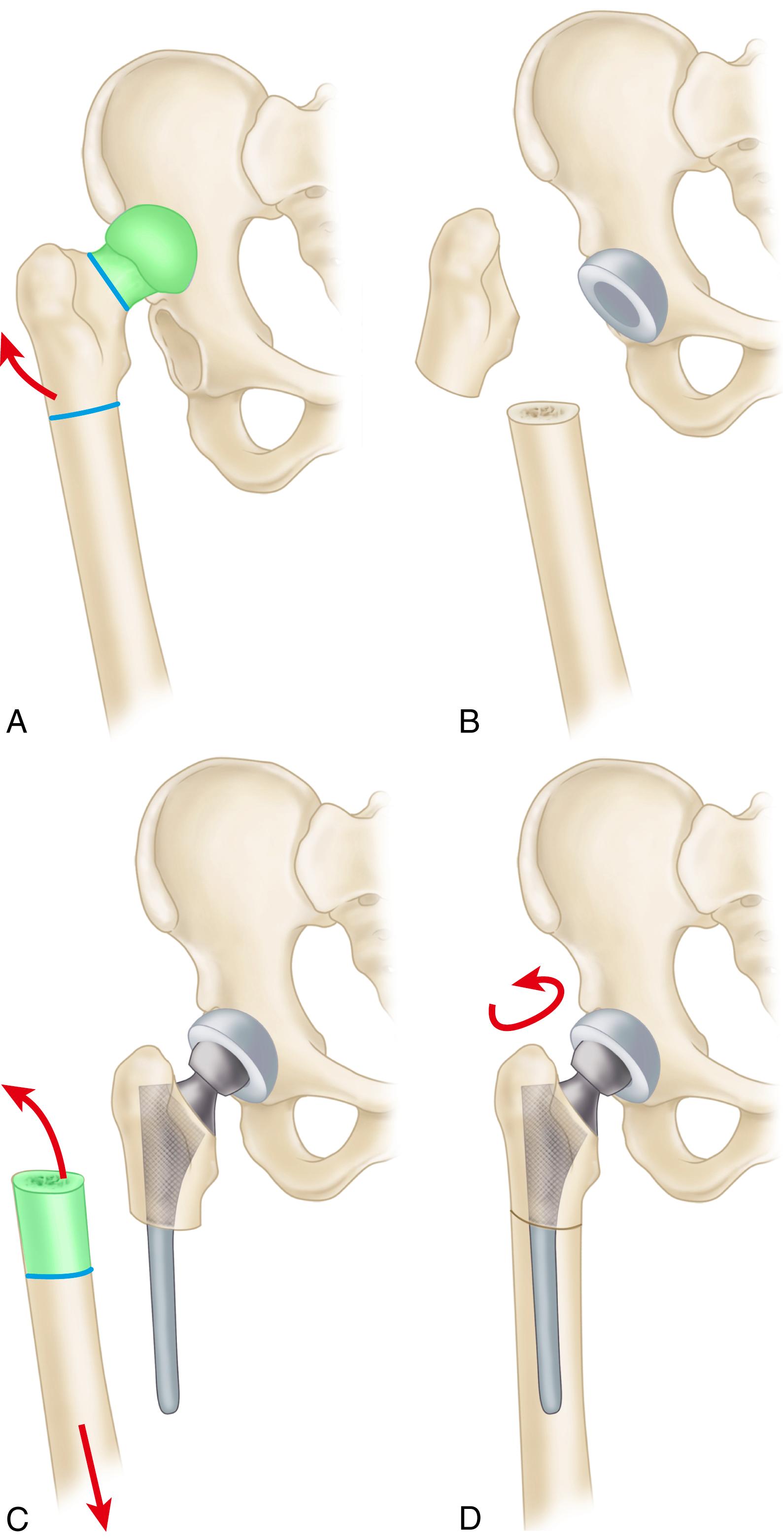 FIGURE 3.91, Subtrochanteric femoral shortening osteotomy. A, Initial femoral osteotomy is made at subtrochanteric level. B, Proximal femur is retracted to expose level of true acetabulum, and socket is placed in anatomic location. C, Proximal femoral fragment is prepared, and trial reduction is done with femoral component placed only in proximal fragment. Traction is applied to distal femoral fragment, and overlapping portion of femur is resected. D, Femoral fragments are reduced, and excessive femoral anteversion is corrected. Femoral component provides intramedullary fixation of osteotomy.