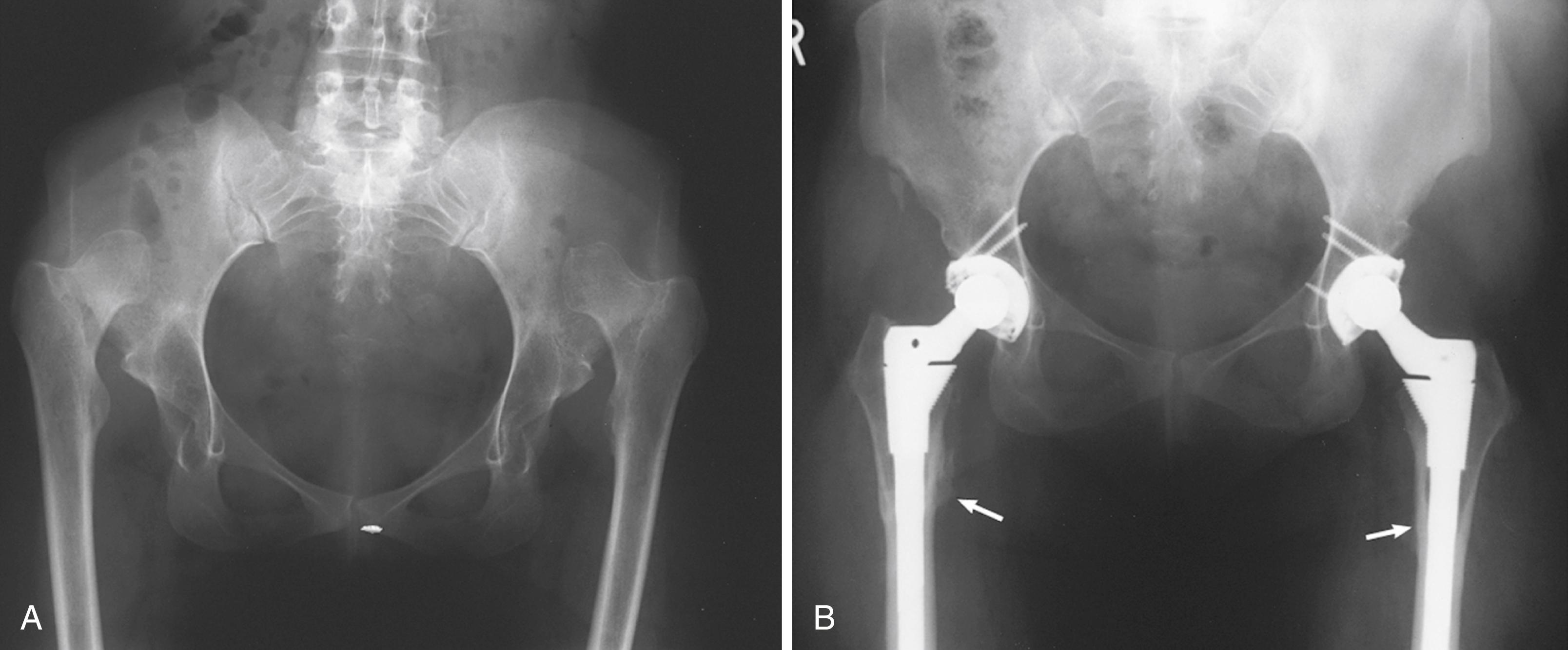 FIGURE 3.92, Subtrochanteric femoral shortening osteotomy. A, Bilateral high congenital dislocations and progressive pain in 35-year-old woman. B, After bilateral, staged, total hip arthroplasties. Both sides were lengthened about 3 cm despite removal of 6-cm segment of femur. Femoral osteotomies (arrows) united uneventfully by 3 months with modular, fluted femoral components.