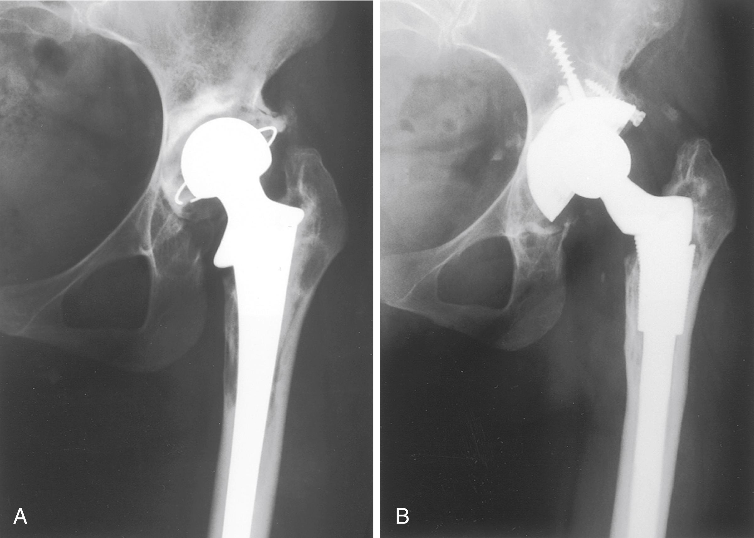 FIGURE 3.93, Trochanteric impingement. A, Total hip replacement in patient with congenital hip dislocation. Valgus neck with little offset produced trochanteric impingement in abduction. Motion was severely limited. B, After revision for loosening with progressive osteolysis. Stem with greater offset restored adequate abduction.