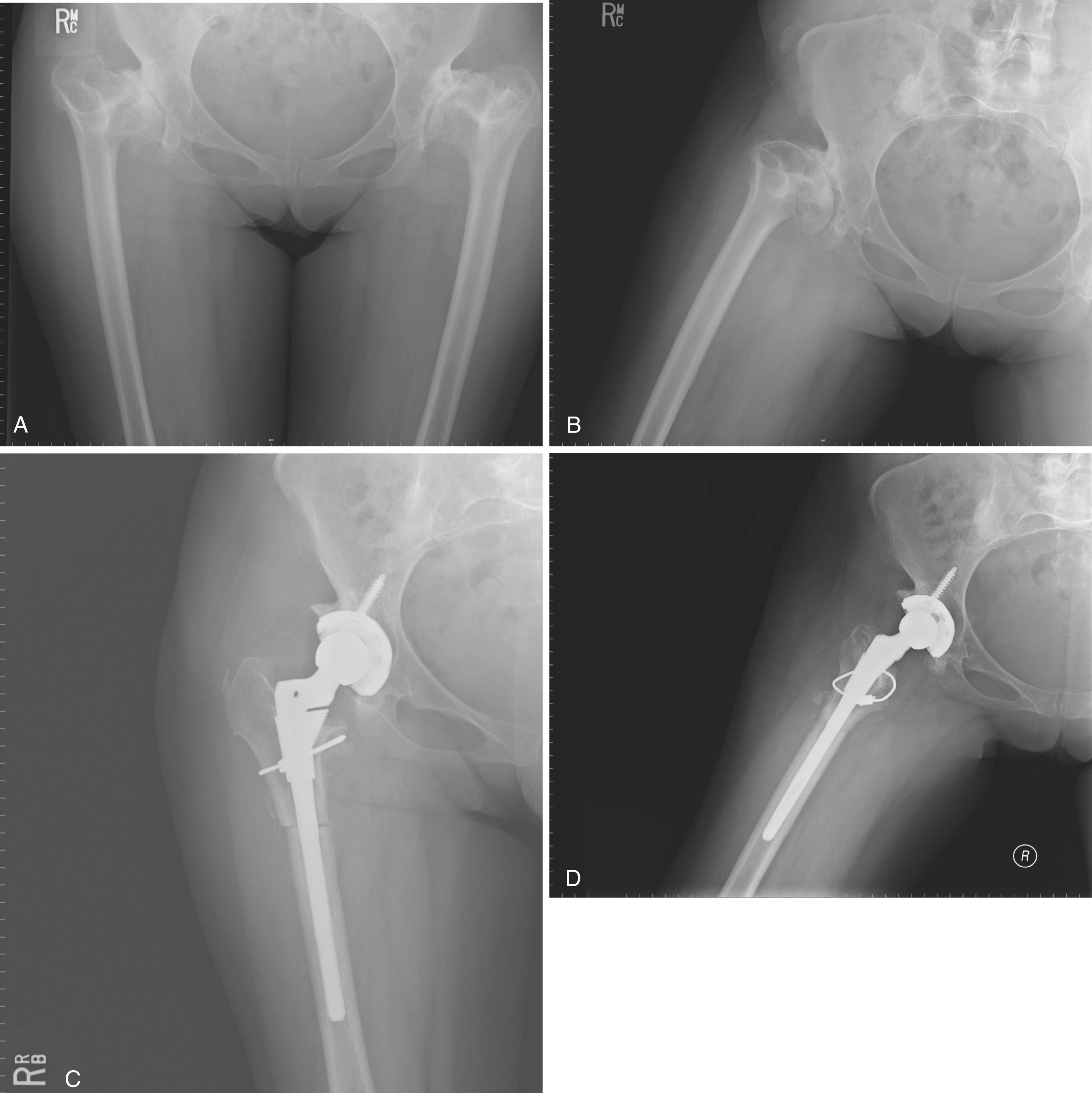 FIGURE 3.94, Painful hip in dwarfism. A and B, Thirty-five-year-old woman with spondyloepiphyseal dysplasia. Femoral canal measures only 7 mm. C and D, After reconstruction with miniature components and 22-mm head. Femoral shortening and derotational osteotomy were required to correct deformity.