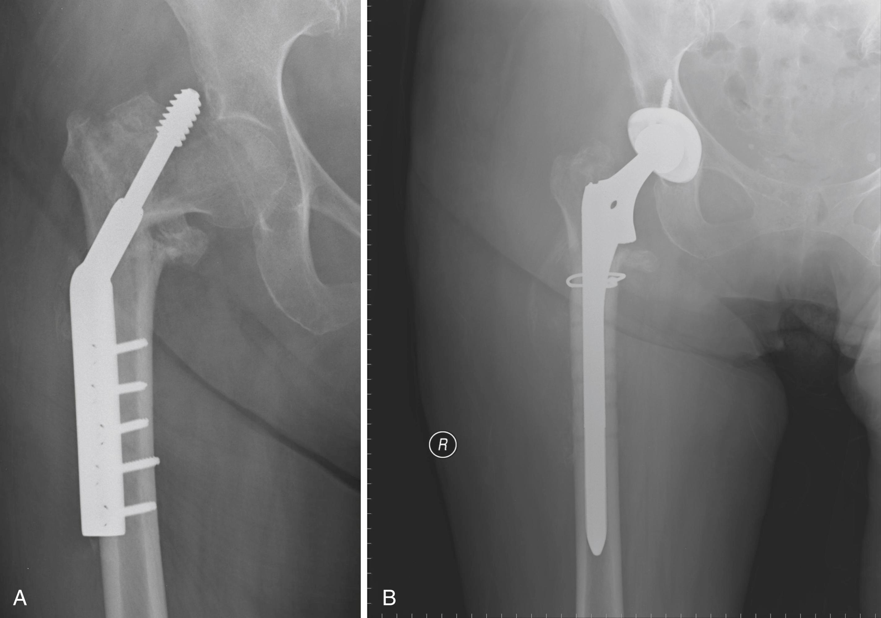 FIGURE 3.95, Nonunion of trochanteric fracture. A, Eight weeks after internal fixation, lag screw was cut out, creating large cavitary defect in head and neck. Repeat fixation is unlikely to succeed. B, Calcar replacement femoral component was required to restore length. Long stem bypasses screw holes by two bone diameters.