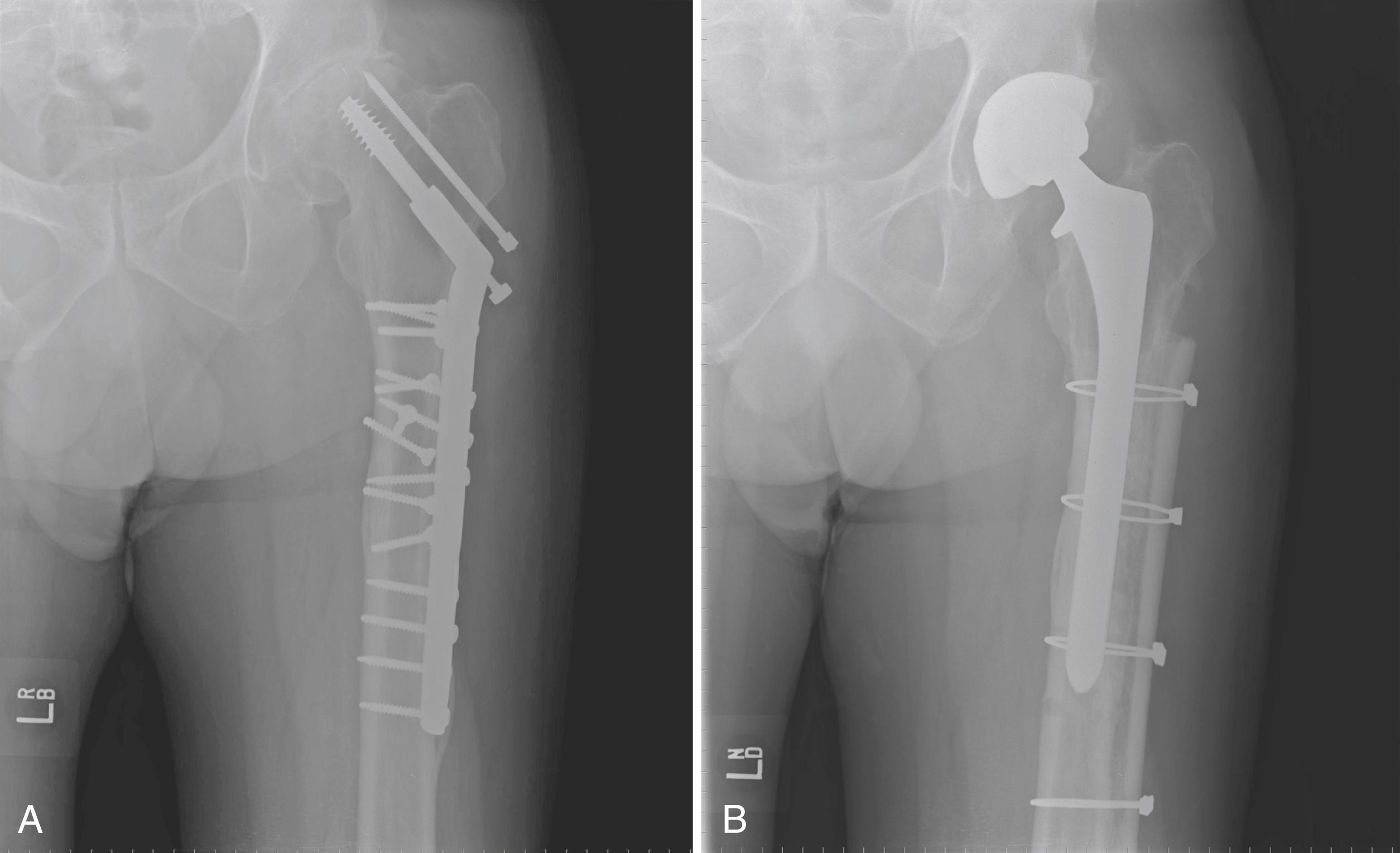 FIGURE 3.96, Femoral strut grafting. A, A 52-year-old man 25 years after plating of comminuted trochanteric fracture with shaft extension. Multiple screws were intracortical and difficult to remove. Lateral femoral cortex under plate was thin with multiple defects from screw removal. B, Long allograft cortical strut was used to avoid an excessively long stem.