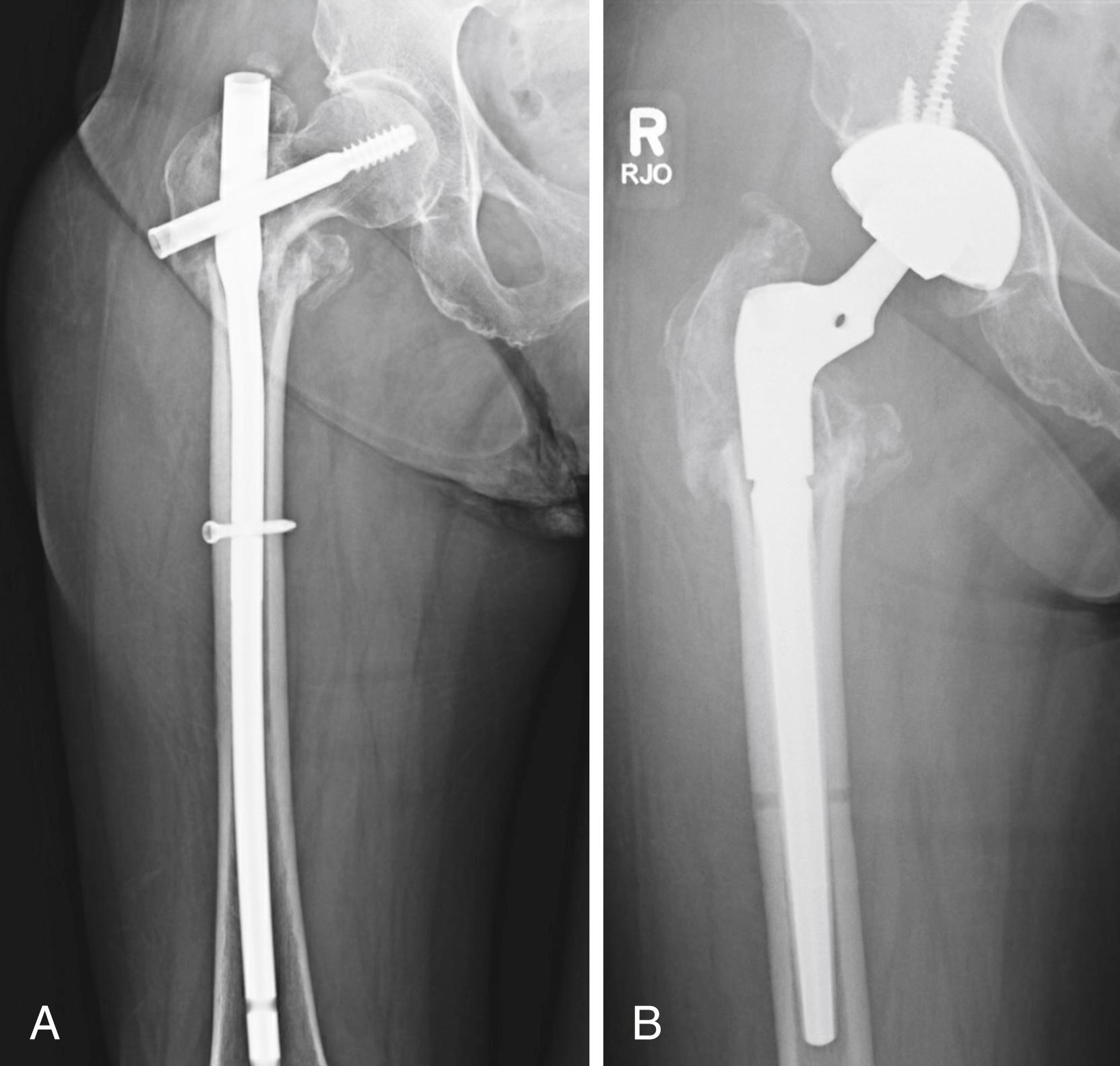 FIGURE 3.97, Broken intramedullary nail. A, Six months after cephalomedullary fixation of trochanteric fracture, nail has broken with fracture nonunion. B, Tapered cementless femoral component. Greater trochanter was united although with defect in abductor mechanism from prior surgery.