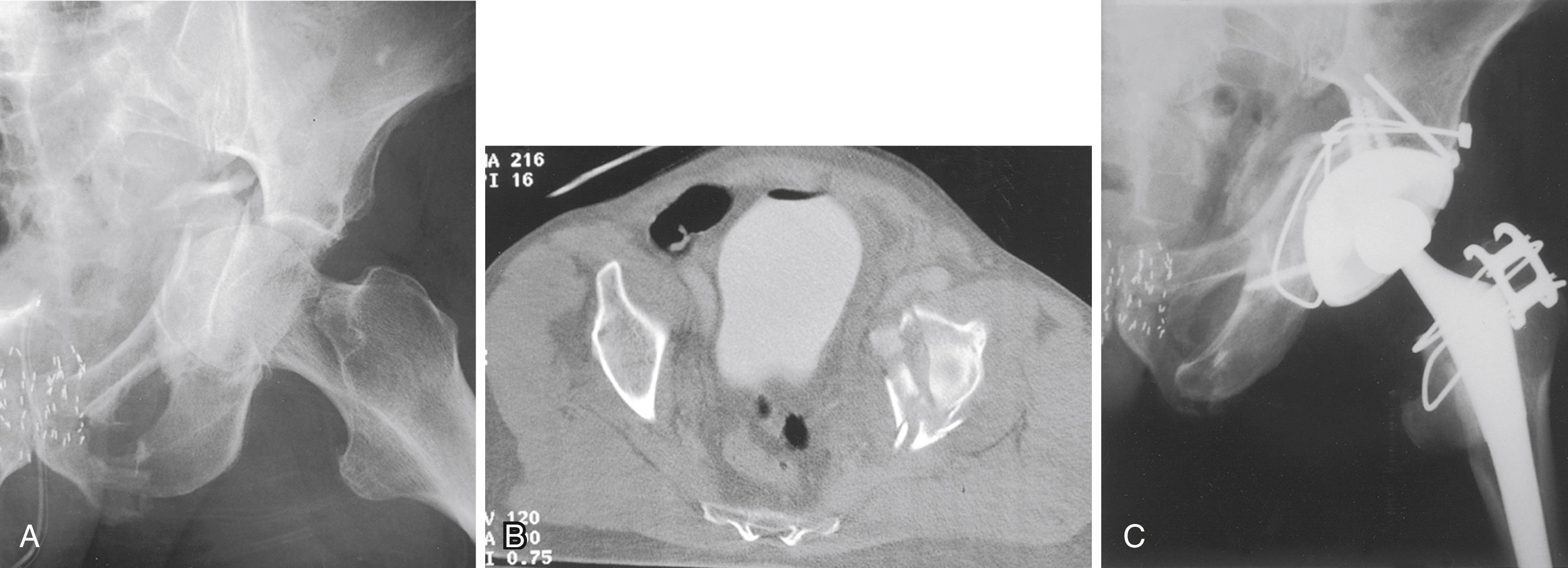 FIGURE 3.98, Primary total hip with acute acetabular fracture. A, Elderly man with mild preexisting arthritis of hip had moderately comminuted T-type fracture of acetabulum. B, CT scan showing comminution of weight-bearing area of acetabular dome. C, Fracture was fixed with lag screws and figure-of-eight braided cable. Primary total hip accomplished with cementless acetabular component fixed with multiple screws. Fracture is united, implants are well positioned, and fixation is stable.