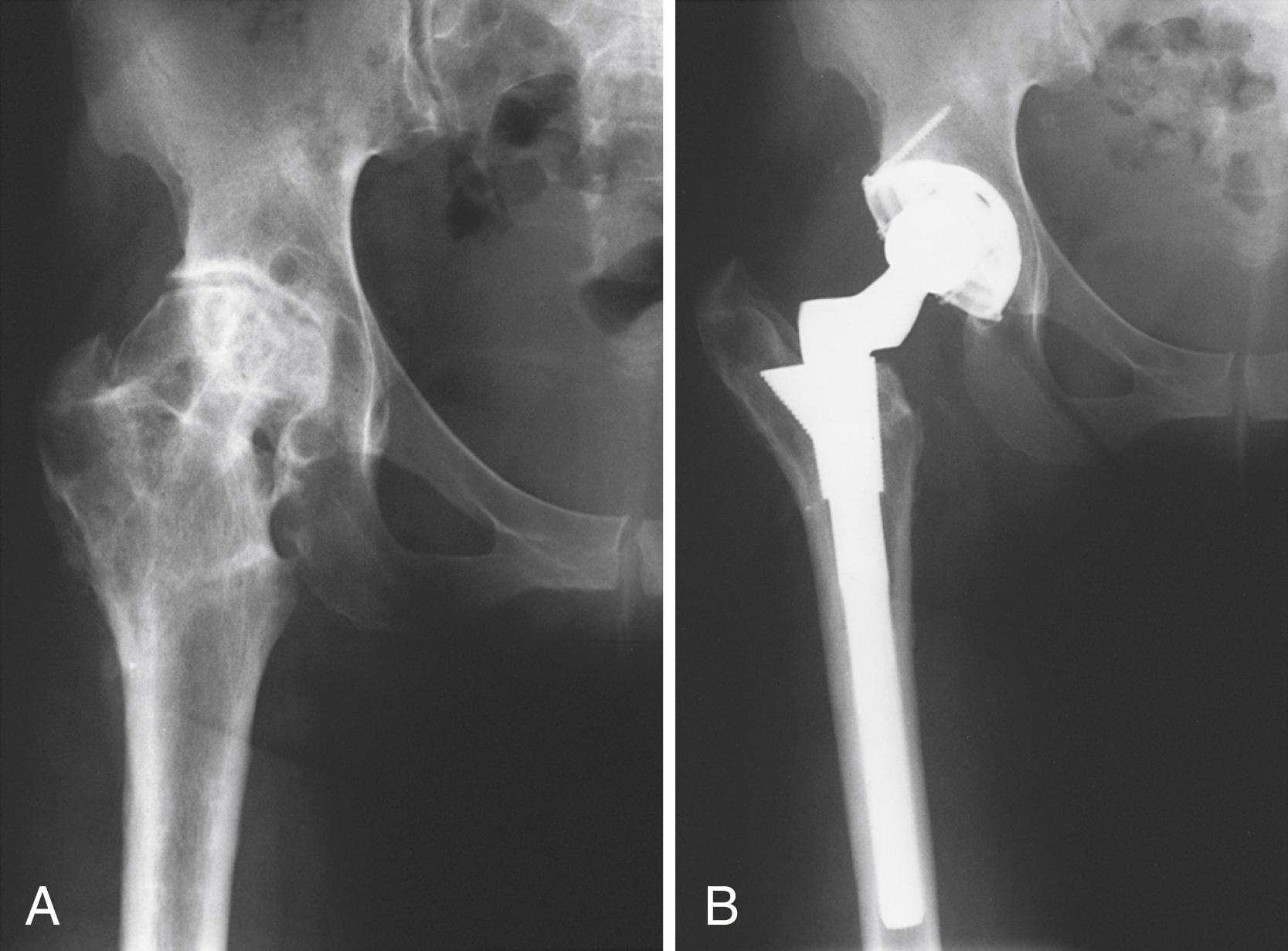 FIGURE 3.99, Femoral osteotomy. A, Prior valgus femoral osteotomy for posttraumatic osteonecrosis in 42-year-old woman. Mild deformity of proximal femur is present. B, After reconstruction with modular stem with sleeve reversed. Repeat osteotomy was avoided.