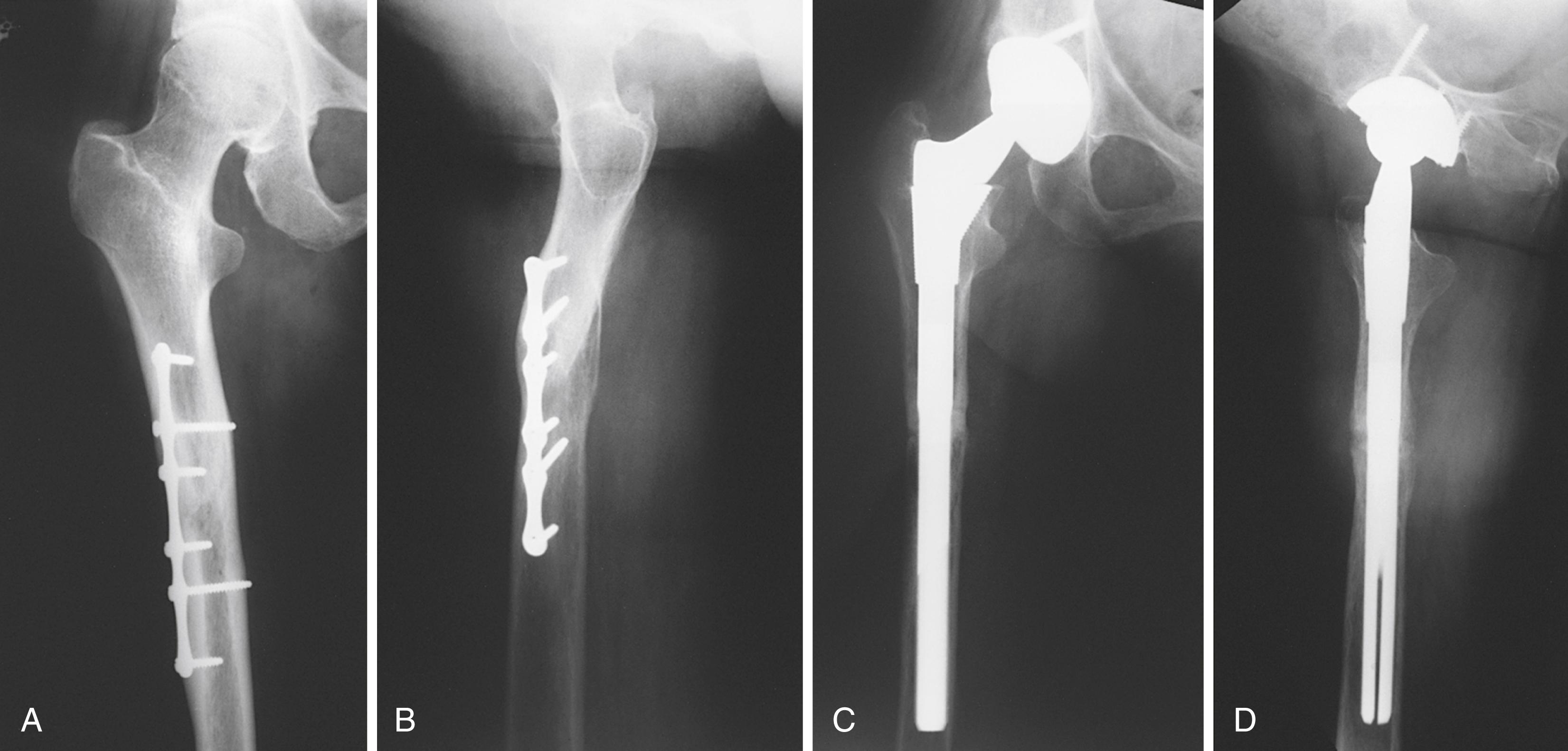 FIGURE 3.100, Femoral osteotomy. A and B, Significant anterior angulation with rotational malunion and canal stenosis in 68-year-old woman after femoral osteotomy in childhood. C and D, Repeat osteotomy was required for correction of deformity before femoral component could be implanted.