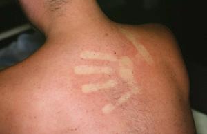 Fig. 1.18, Typical dengue rash.