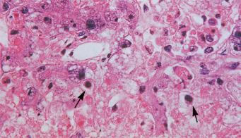 Fig. 1.29, Section of liver from a fatal case of yellow fever.