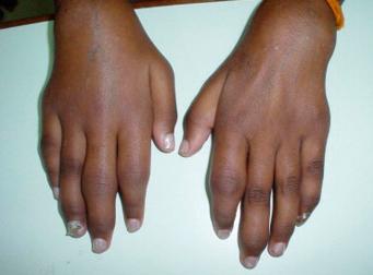 Fig. 1.31, Acute arthritis of the interphalangeal joints in a patient with chikungunya.