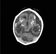 Fig. 1.36, CT scan abnormalities in congenital Zika virus syndrome.