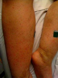 Fig. 1.40, Maculopapular rash in West Nile virus (WNV).