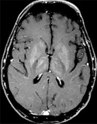 Fig. 1.42, MRI of an immunocompromised patient with West Nile virus (WNV).