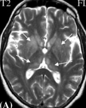 Fig. 1.50, MRI changes in acute Japanese encephalitis virus (JEV).