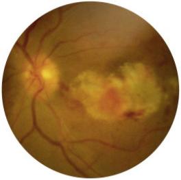 Fig. 1.53, Retinitis in a patient with Rift Valley fever virus (RFVF).