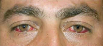 Fig. 1.57, Bilateral subconjunctival haemorrhage.