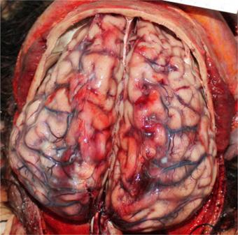 Fig. 1.58, Subarachnoid haemorrhage in a patient who died of Crimean-Congo haemorrhagic fever.