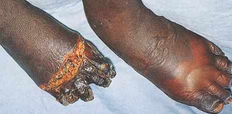 Fig. 1.62, Peripheral gangrene in severe epidemic typhus.