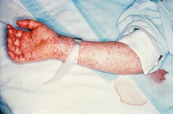 Fig. 1.66, Petechial rash of Rocky Mountain spotted fever (RMSF).