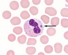 Fig. 1.76, Intraleukocytic inclusion body (morula) of Anaplasma phagocytophilum causing human granulocytic anaplasmosis.