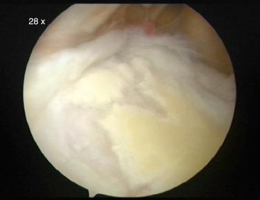 FIG. 53.1, Degenerative type I SLAP tear as viewed from a posterior portal.