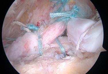 FIG. 25.2, Right shoulder, lateral portal view of a functional rotator cuff repair. A U-shaped lesion has been repaired by performing one side-to-side repair at the apex of the lesion in order to reduce the tension of the repair and by placing one anterior and one posterior anchor in order to reestablish the force couple balance. An additional side-to-side repair has been performed with one suture of the anterior anchor.