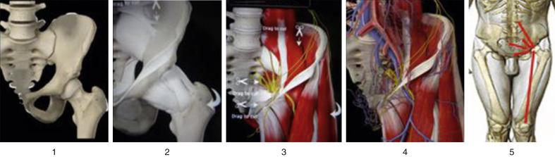 • Fig. 43.1, The five levels of the hip consist of the (1) osseous, (2) capsulolabral, (3) musculotendinous, (4) neurovascular, and (5) kinematic chain.