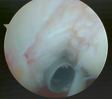 FIG. 18.1, Partial articular supraspinatus tendon avulsion (PASTA) lesion with uncovered footprint.