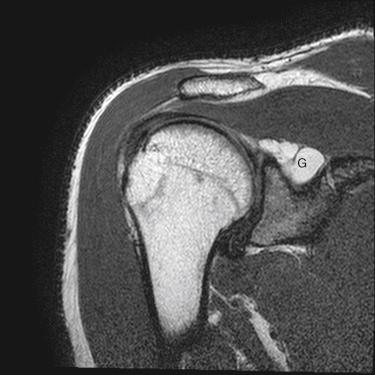 FIG. 52.1, Typical magnetic resonance image of a ganglion cyst with a superior labrum anterior to posterior lesion. This T2-weighted coronal image shows a well-marginated, round-shaped lesion with a high signal just medial to the superior labrum, consistent with a ganglion cyst, and an intermediate low signal extending through the superior labrum, consistent with a superior labral tear. G, ganglion.