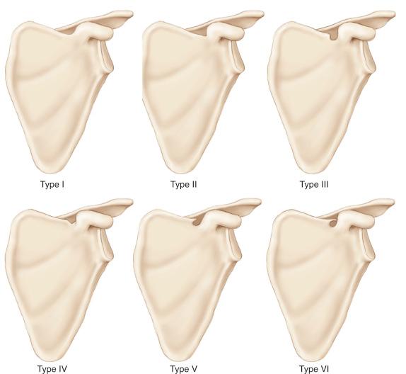 FIG. 52.3, Classification of suprascapular notch anatomy by Rengachary et al. The incidences of each type are as follows: Type I, 8%; Type II, 31%; Type III, 48%; Type IV, 3%; Type V, 6%; and Type VI, 4%.