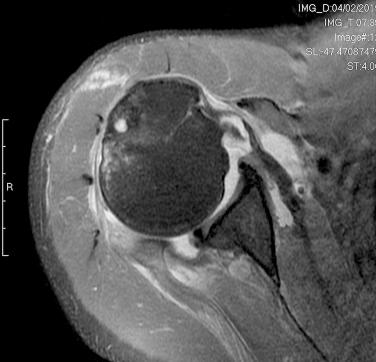 FIG. 22.1, Tear of the supraspinatus (magnetic resonance imaging).